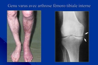 Genu varus avec arthrose fémoro tibiale interneGenu varus avec arthrose fémoro tibiale interne
 