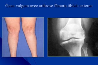 Genu valgum avec arthrose fémoro tibiale externeGenu valgum avec arthrose fémoro tibiale externe
 