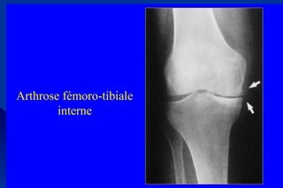 Arthrose fémoro-tibiale
interne
 