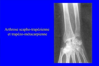 Arthrose scapho-trapézienne
et trapézo-métacarpienne
 