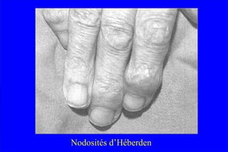 Nodosités d’Héberden
 