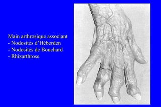 Main arthrosique associant
- Nodosités d’Héberden
- Nodosités de Bouchard
- Rhizarthrose
 