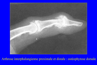 Arthrose interphalangienne proximale et distale : ostéophytose dorsale
 