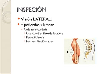 INSPECIÓN
Visión    LATERAL:
Hiperlordosis      lumbar
 ◦ Puede ser secundaria
    Una actitud en flexo de la cadera
    Espondilolistesis
    Horizontalización sacro
 