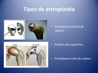 Tipos de artroplastia
• Artroplastia parcial de
cadera.

• Prótesis de superficie.

• Artroplastia total de cadera.

 