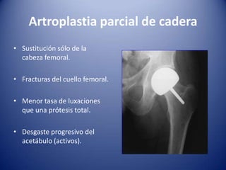 Artroplastia parcial de cadera
• Sustitución sólo de la
cabeza femoral.
• Fracturas del cuello femoral.

• Menor tasa de luxaciones
que una prótesis total.
• Desgaste progresivo del
acetábulo (activos).

 