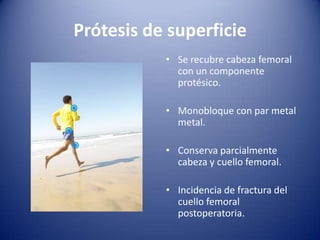 Prótesis de superficie
• Se recubre cabeza femoral
con un componente
protésico.
• Monobloque con par metal
metal.

• Conserva parcialmente
cabeza y cuello femoral.
• Incidencia de fractura del
cuello femoral
postoperatoria.

 