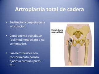 Artroplastia total de cadera
• Sustitución completa de la
articulación.

• Componente acetabular
(polimetilmetacrilato o no
cementado).
• Son hemisféricos con
recubrimiento poroso
fijados a presión (press –
fit).

 