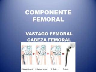 COMPONENTE
FEMORAL
VASTAGO FEMORAL
CABEZA FEMORAL

 