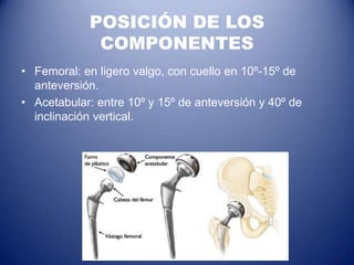 POSICIÓN DE LOS
COMPONENTES
• Femoral: en ligero valgo, con cuello en 10º-15º de
anteversión.
• Acetabular: entre 10º y 15º de anteversión y 40º de
inclinación vertical.

 