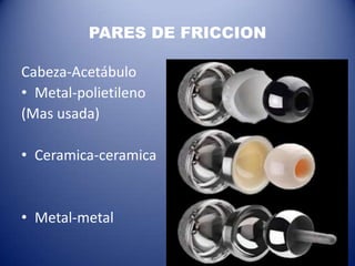 PARES DE FRICCION
Cabeza-Acetábulo
• Metal-polietileno
(Mas usada)

• Ceramica-ceramica

• Metal-metal

 