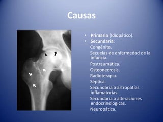 Causas
• Primaria (Idiopático).
• Secundaria:
Congénita.
Secuelas de enfermedad de la
infancia.
Postraumática.
Osteonecrosis.
Radioterapia.
Séptica.
Secundaria a artropatías
inflamatorias.
Secundaria a alteraciones
endocrinológicas.
Neuropática.

 