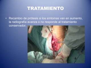 TRATAMIENTO
• Recambio de prótesis si los síntomas van en aumento,
la radiografía avanza o no responde al tratamiento
conservador.

 