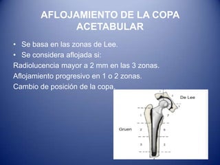 AFLOJAMIENTO DE LA COPA
ACETABULAR
• Se basa en las zonas de Lee.
• Se considera aflojada si:
Radiolucencia mayor a 2 mm en las 3 zonas.
Aflojamiento progresivo en 1 o 2 zonas.
Cambio de posición de la copa.

 