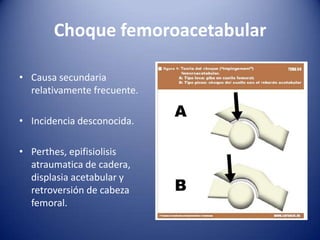 Choque femoroacetabular
• Causa secundaria
relativamente frecuente.

• Incidencia desconocida.
• Perthes, epifisiolisis
atraumatica de cadera,
displasia acetabular y
retroversión de cabeza
femoral.

 