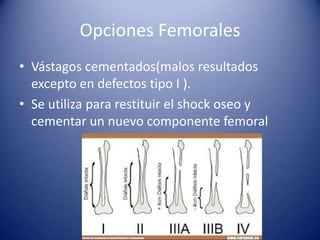 Opciones Femorales
• Vástagos cementados(malos resultados
excepto en defectos tipo I ).
• Se utiliza para restituir el shock oseo y
cementar un nuevo componente femoral

 
