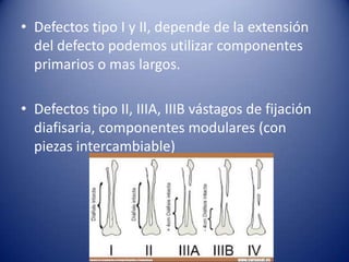 • Defectos tipo I y II, depende de la extensión
del defecto podemos utilizar componentes
primarios o mas largos.

• Defectos tipo II, IIIA, IIIB vástagos de fijación
diafisaria, componentes modulares (con
piezas intercambiable)

 
