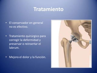 Tratamiento
• El conservador en general
no es efectivo.
• Tratamiento quirúrgico para
corregir la deformidad y
preservar o reinsertar el
labrum.
• Mejora el dolor y la función.

 