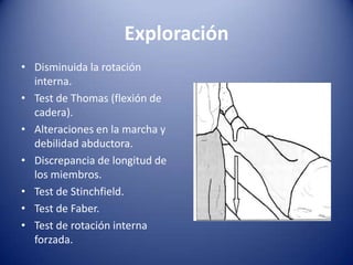 Exploración
• Disminuida la rotación
interna.
• Test de Thomas (flexión de
cadera).
• Alteraciones en la marcha y
debilidad abductora.
• Discrepancia de longitud de
los miembros.
• Test de Stinchfield.
• Test de Faber.
• Test de rotación interna
forzada.

 