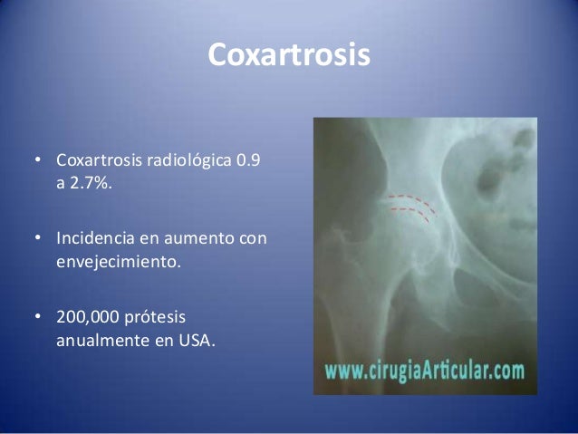 Coxartrosis