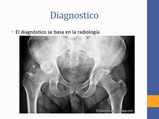 Diagnostico
• El diagnóstico se basa en la radiología
 