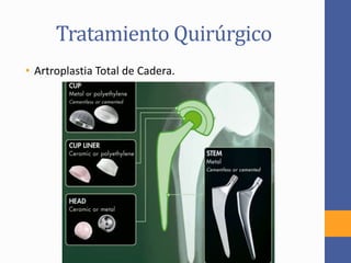 Tratamiento Quirúrgico
• Artroplastia Total de Cadera.
 