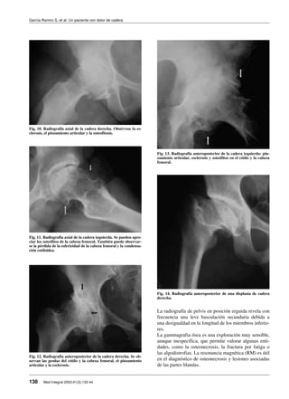 La radiografía de pelvis en posición erguida revela con
frecuencia una leve basculación secundaria debida a
una desigualdad en la longitud de los miembros inferio-
res.
La gammagrafia ósea es una exploración muy sensible,
aunque inespecífica, que permite valorar algunas enti-
dades, como la osteonecrosis, la fractura por fatiga o
las algodistrofias. La resonancia magnética (RM) es útil
en el diagnóstico de osteonecrosis y lesiones asociadas
de las partes blandas.
García Ramiro S, et al. Un paciente con dolor de cadera
138 Med Integral 2003;41(3):133-44
Fig. 10. Radiografía axial de la cadera derecha. Obsérvese la es-
clerosis, el pinzamiento articular y la osteofitosis.
Fig. 11. Radiografía axial de la cadera izquierda. Se pueden apre-
ciar los osteófitos de la cabeza femoral. También puede observar-
se la pérdida de la esfericidad de la cabeza femoral y la condensa-
ción cotiloidea.
Fig. 12. Radiografía anteroposterior de la cadera derecha. Se ob-
servan las geodas del cótilo y la cabeza femoral, el pinzamiento
articular y la esclerosis.
Fig. 13. Radiografía anteroposterior de la cadera izquierda: pin-
zamiento articular, esclerosis y osteófitos en el cótilo y la cabeza
femoral.
Fig. 14. Radiografía anteroposterior de una displasia de cadera
derecha.
 