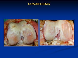 GONARTROZA
 
