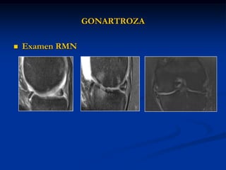 GONARTROZA
 Examen RMN
 