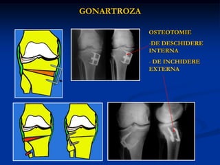GONARTROZA
OSTEOTOMIE
-DE DESCHIDERE
INTERNA
- DE INCHIDERE
EXTERNA
 