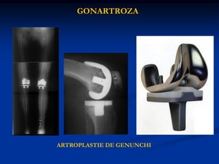 GONARTROZA
ARTROPLASTIE DE GENUNCHI
 