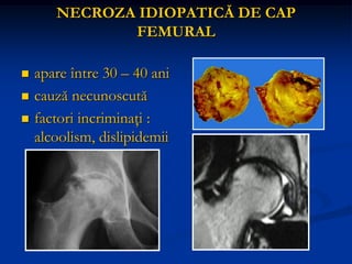 NECROZA IDIOPATICĂ DE CAP
FEMURAL
 apare între 30 – 40 ani
 cauză necunoscută
 factori incriminaţi :
alcoolism, dislipidemii
 