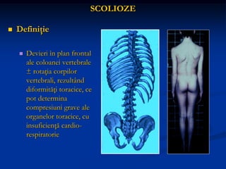 SCOLIOZE
 Definiţie
 Devieri în plan frontal
ale coloanei vertebrale
± rotaţia corpilor
vertebrali, rezultând
diformităţi toracice, ce
pot determina
compresiuni grave ale
organelor toracice, cu
insuficienţă cardio-
respiratorie
 