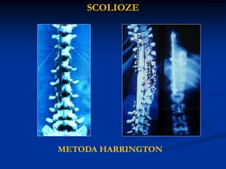 SCOLIOZE
METODA HARRINGTON
 