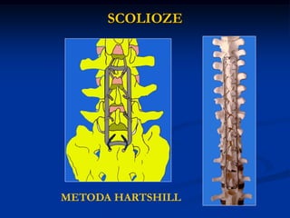 SCOLIOZE
METODA HARTSHILL
 