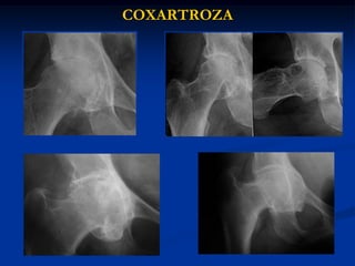 COXARTROZA
 