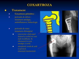 COXARTROZA
 Tratament
 Coxartroze primitive :
 perioada de debut :
tratament antialgic,
antiinflamator, balneologic
 perioada de stare:
tratament chirurgical
 osteotomie: când capul
femural şi cotilul nu sunt
mult modificate. Se
efectuează în scop
antialgic şi trofic
 artroplastie totală de şold
cu proteză
cimentată/necimentată
 