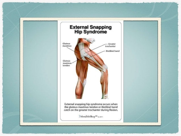 coxa sultans external snapping hip snapping hip syndrome