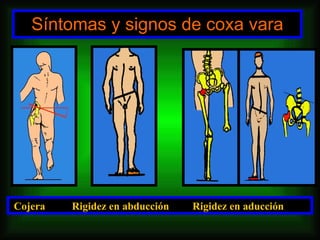 Síntomas y signos de coxa vara Cojera  Rigidez en abducción   Rigidez en aducción 