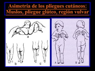Asimetría de los pliegues cutáneos: Muslos, pliegue glúteo, región vulvar 