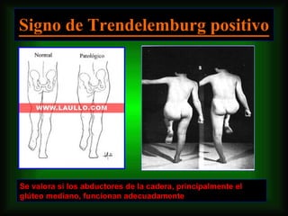Signo de Trendelemburg positivo Se valora si los abductores de la cadera, principalmente el glúteo mediano, funcionan adecuadamente  