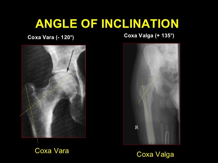coxa vara 25 728 jpg cb 1251194780 coxa vara