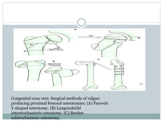 Congenital coxa vara. Surgical methods of valgus-producing 
proximal femoral osteotomies. (A) Pauwels 
Y-shaped osteotomy. (B) Langenskiöld 
intertrochanteric osteotomy. (C) Borden 
subtrochanteric osteotomy. 
 