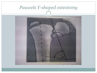 Pauwels Y-shaped osteotomy 
 