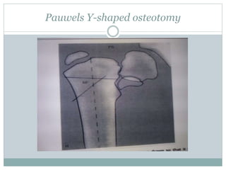 Pauwels Y-shaped osteotomy 
 