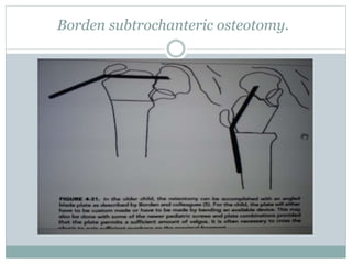 Borden subtrochanteric osteotomy. 
 