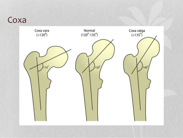 Coxa Vara Genu Varum Valgum Under Gradts