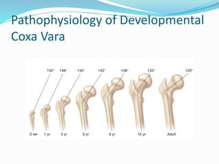 Pathophysiology of Developmental
Coxa Vara
 
