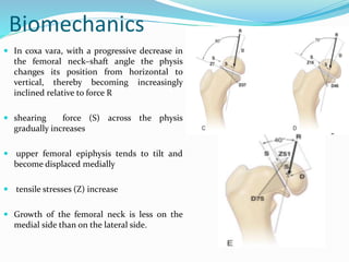 Biomechanics
 In coxa vara, with a progressive decrease in
the femoral neck–shaft angle the physis
changes its position from horizontal to
vertical, thereby becoming increasingly
inclined relative to force R
 shearing force (S) across the physis
gradually increases
 upper femoral epiphysis tends to tilt and
become displaced medially
 tensile stresses (Z) increase
 Growth of the femoral neck is less on the
medial side than on the lateral side.
 