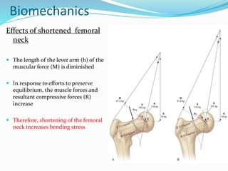 Biomechanics
Effects of shortened femoral
neck
 The length of the lever arm (h) of the
muscular force (M) is diminished
 In response to efforts to preserve
equilibrium, the muscle forces and
resultant compressive forces (R)
increase
 Therefore, shortening of the femoral
neck increases bending stress
 